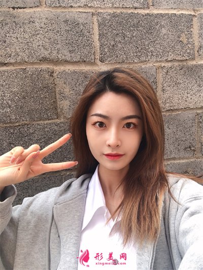 北京小姐姐鼻翼縮小術(shù)后效果反饋