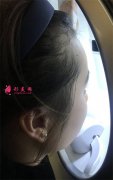 杭州杭州華山連天美皮秒激光術(shù)后恢復(fù)情況對(duì)比