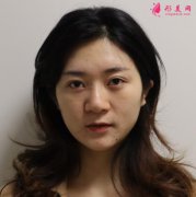 廣州曙光醫(yī)院陳鵬做鼻子怎么樣？來看看隆鼻案例~