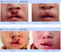 兔唇的最佳治療時間是多少歲?