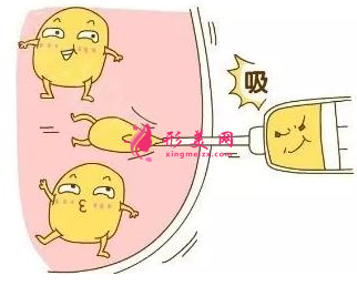 腰腹部吸脂減肥手術(shù)安不安全呢