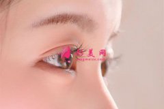 雙眼皮失敗修復(fù)大概要多少錢？