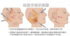 拉皮手術(shù)大概需要多少錢(qián)?大拉皮和小拉皮手術(shù)有什么區(qū)別?