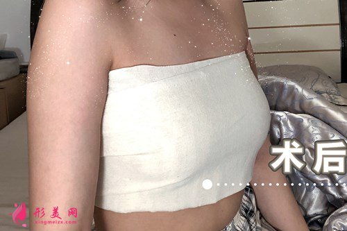 廣州假體隆胸效果分享