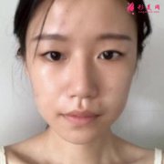 鄭州第二附屬醫(yī)院割雙眼皮價(jià)格收費(fèi)標(biāo)準(zhǔn)分享中~含案例對(duì)比圖