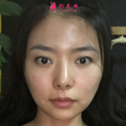 廣州曙光面部自體脂肪填充效果分享，女神進(jìn)化史