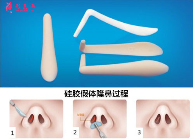 假體隆鼻多長時(shí)間才可以捏鼻子