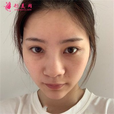 深圳假體隆鼻術后恢復情況反饋