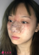 鼻頭肥大拍照超明顯，上海華美整形美容醫(yī)院做個(gè)鼻綜合就能改善