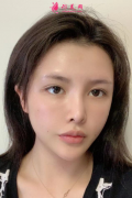 上海藝星整形醫(yī)院做個(gè)自體脂肪全臉填充怎么樣？附上案例