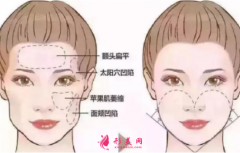 自體脂肪填充臉部后需要注意什么？