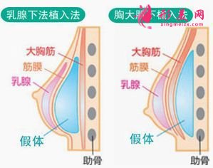 假體隆胸后會(huì)痛多長(zhǎng)時(shí)間