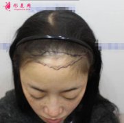 上海九院植發(fā)怎么樣?分享下我的經(jīng)歷及術(shù)后效果圖