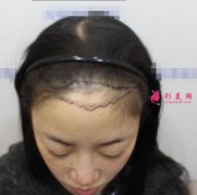 上海九院植發(fā)掛什么科?分享下我的經(jīng)歷及術(shù)后效果圖