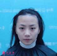 八大處整形醫(yī)院植發(fā)怎么樣？案例效果圖給你真實參考