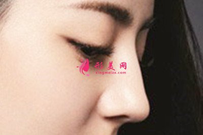 假體隆鼻術(shù)后需要注意什么問題