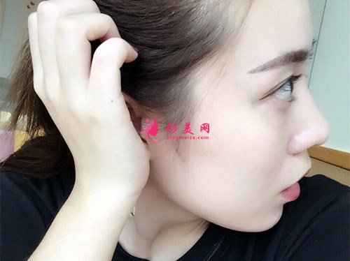 成都打玻尿酸豐面頰手術(shù)效果分享