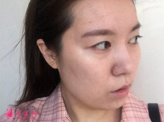 四川華人醫(yī)聯(lián)打玻尿酸豐面頰手術(shù)效果分享