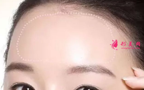 自體脂肪填充臉部后效果好嗎
