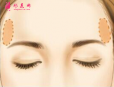 自體脂肪填充臉部的收費(fèi)怎么樣
