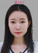 四川友誼醫(yī)院李繼華下頜角磨骨怎么樣？真人案例在線分享