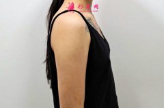 北京煤炭總醫(yī)院假體隆胸手術(shù)效果分享