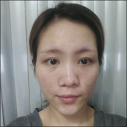 濟南瑞麗醫(yī)療美容醫(yī)院自體軟骨隆鼻的效果圖+術后注意事項分享～
