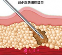 吸脂瘦身要多少錢(qián)？