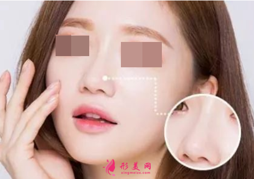 縮鼻翼手術多少錢