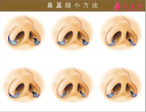 縮鼻翼手術多少錢