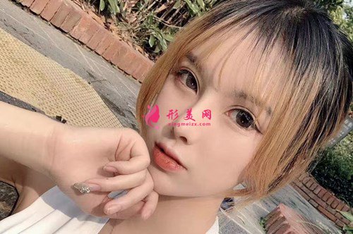 上海顴弓降低手術(shù)分享