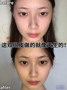 南京美貝爾黃名斗醫(yī)生眼綜合案例，這雙眼皮做的就像天生的！