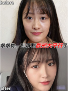 南京美貝爾黃名斗醫(yī)生雙眼皮案例，別再割歐式大平行了！