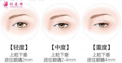 上瞼下垂矯正術(shù)后眼皮太上了怎么辦？
