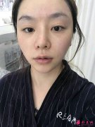 四川友誼醫(yī)院整形科墊下巴怎么樣，附硅膠墊下巴案例