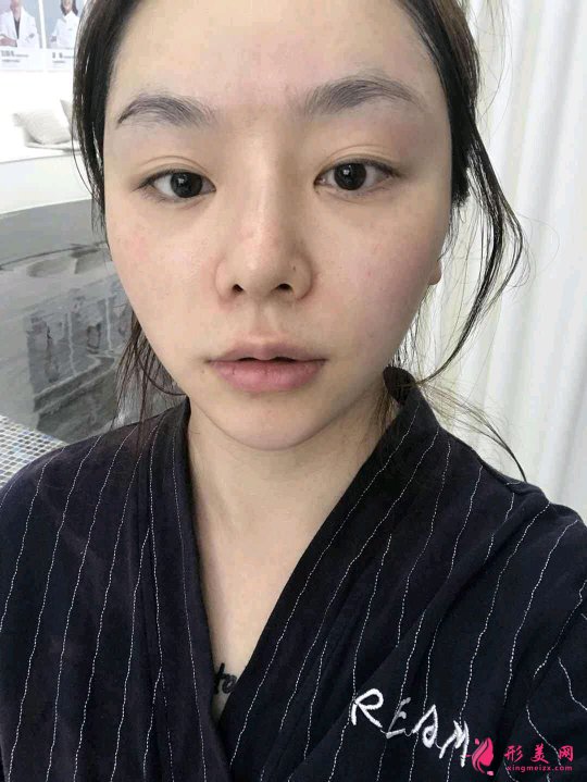 石家莊星源美天整形醫(yī)院價(jià)格表，附硅膠墊下巴案例