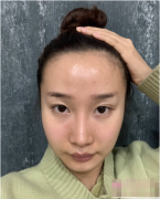 成都恒博植發(fā)怎么樣？植發(fā)案例效果一覽