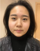 北京潤美玉之光醫(yī)療美容面部吸脂案例一覽
