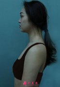 四川米蘭柏羽隆胸怎么樣？自體脂肪隆胸讓自己更有女人味！