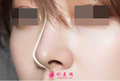 肋軟骨隆鼻后多久能恢復(fù)