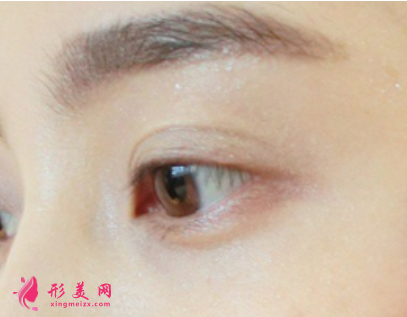 雙眼皮手術(shù)前要注意的事項(xiàng)