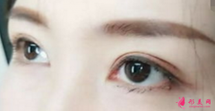 雙眼皮手術(shù)前要注意的事項(xiàng)