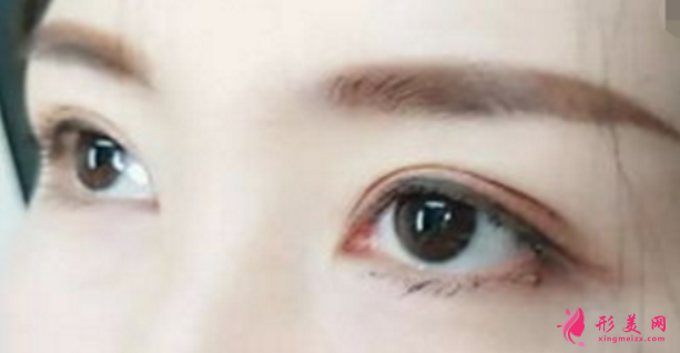 雙眼皮手術(shù)前要注意的事項(xiàng)
