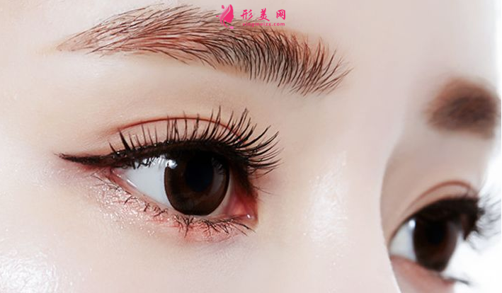 埋線雙眼皮術(shù)后怎么護(hù)理