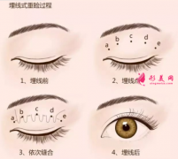 埋線雙眼皮費(fèi)用是多少？