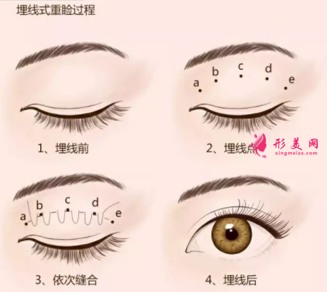 埋線雙眼皮費用是多少