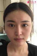 成都哪家醫(yī)院磨顴骨比較好?成都友誼醫(yī)院羅恩醫(yī)生顴骨案例