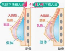 假體隆胸術(shù)適合哪些人群？