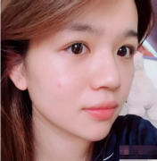 北京八大處熱拉提怎么樣？附上熱拉提前后效果對比