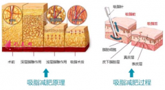 吸脂減肥過程痛不痛